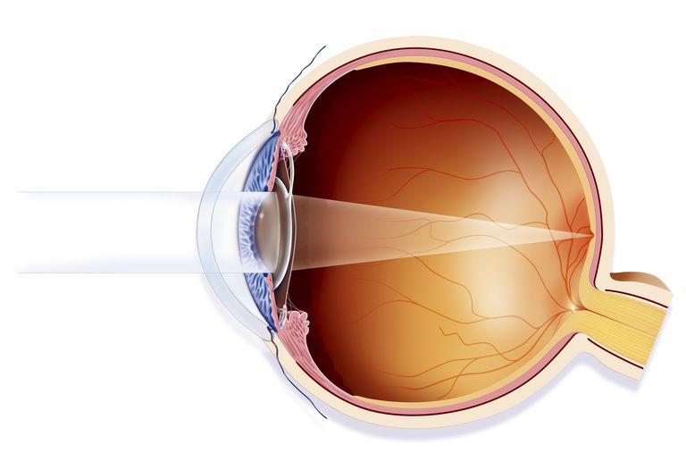 PAM-test inte, annan ögonsjukdom, inte mycket, intraokulärt linsimplantat
