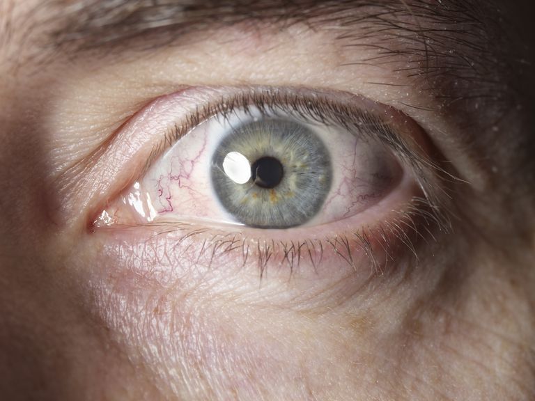 delen ögat, kallas folliklar, pharyngoconjunctival fever