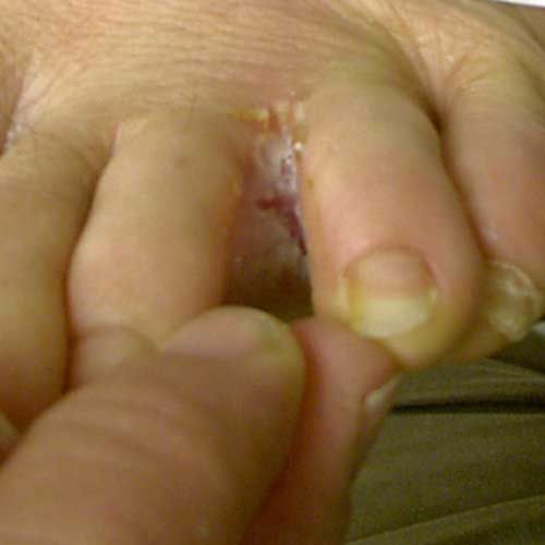 mellan fingrarna, Detta exempel, eller tinea, herpes simplex, Mountain Spotted