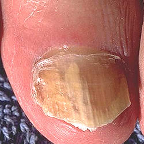 mellan fingrarna, Detta exempel, eller tinea, herpes simplex, Mountain Spotted