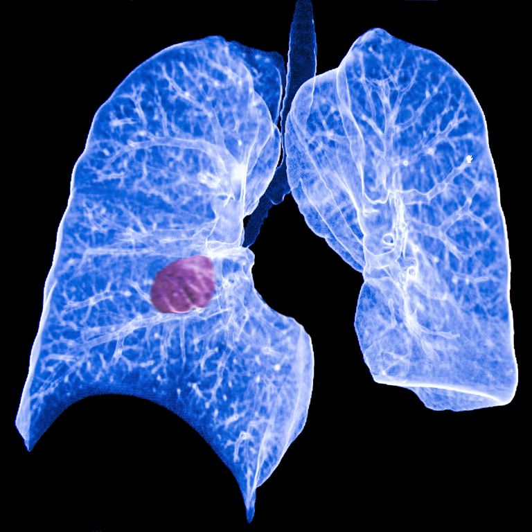 primär lungcancer, delar kroppen, lungcancer vara, sekundär lungcancer, vara primär, vara primär lungcancer