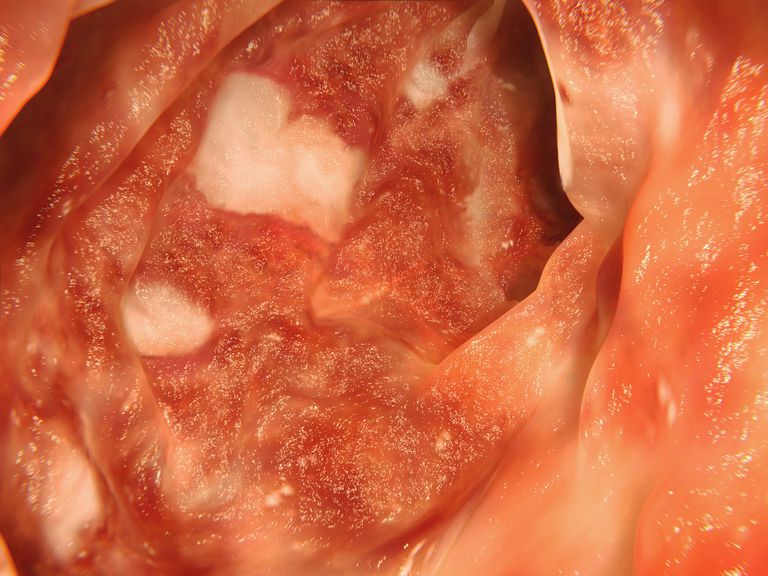 Crohns sjukdom, ulcerös kolit, eller avföringen, blödning från, Blödning från ändtarmen