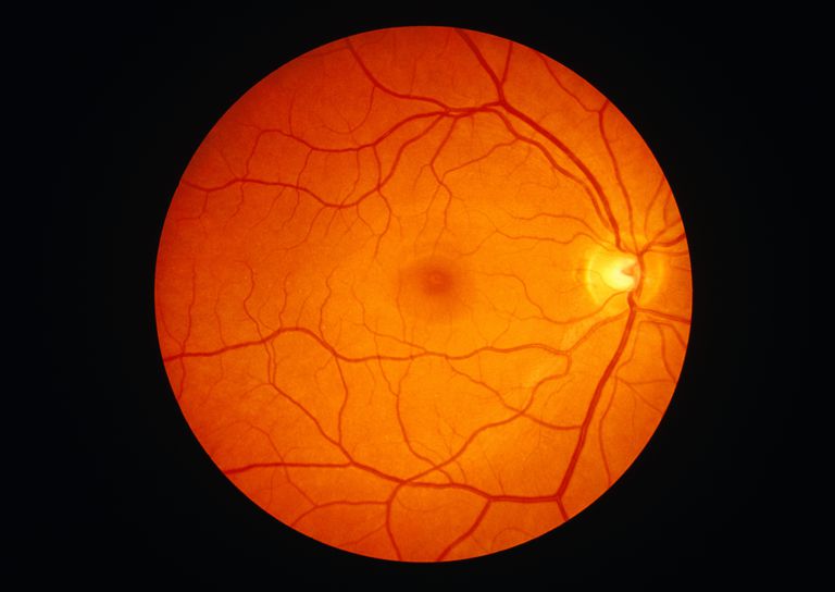 retinal detachment, Exudativ retinalavlossning, hålla näthinnan, kräver omedelbar