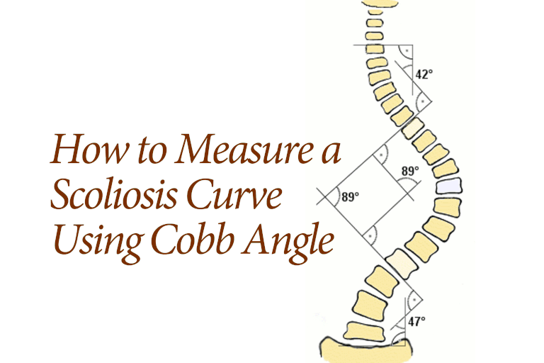 apikala kotan, apikala ryggkotan, eller ditt, börjar linjen, Cobb Angle, Cobb vinklar