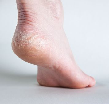atopisk dermatit, form eksem, kliande fötter