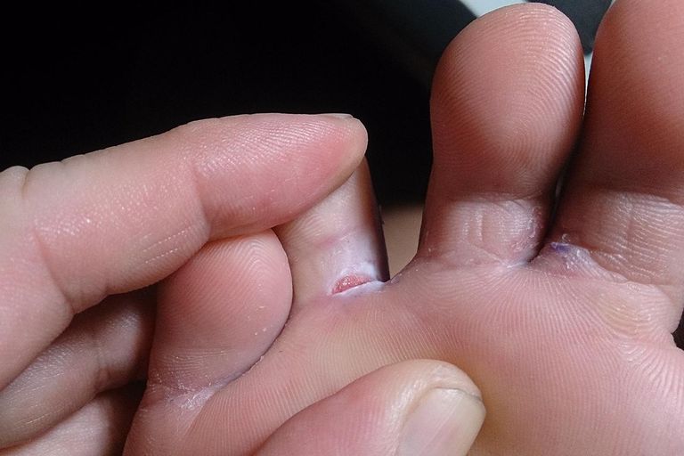 atopisk dermatit, form eksem, kliande fötter