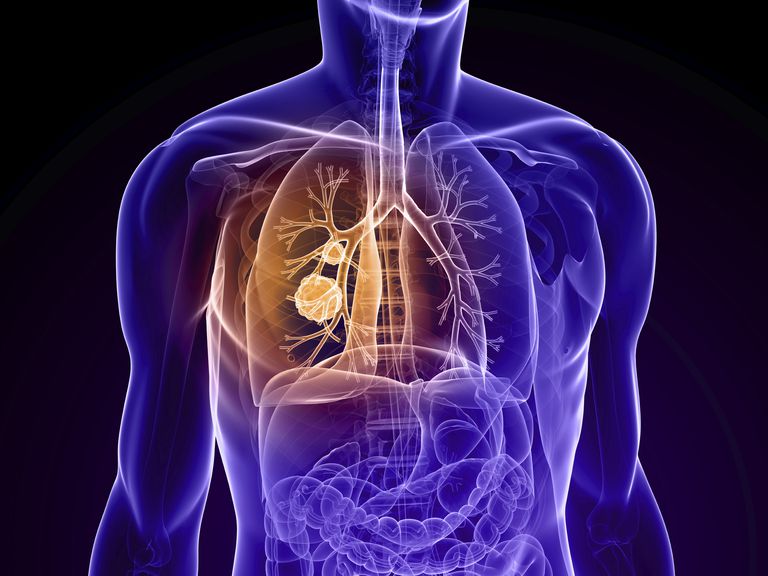 stadium lungcancer, primär lungcancer, andra primär, andra primär lungcancer, andra primära, andra primära cancerformer