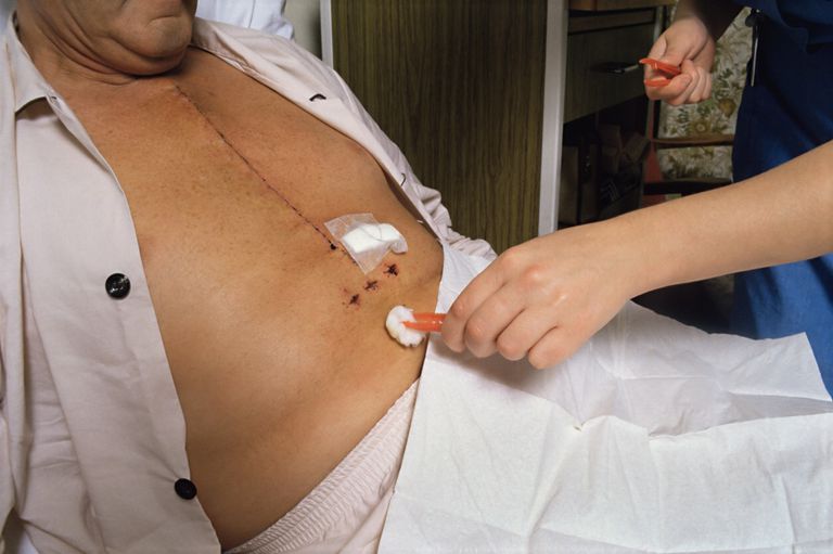 sternala försiktighetsåtgärder, efter öppen, efter öppen hjärtkirurgi, öppen hjärtkirurgi