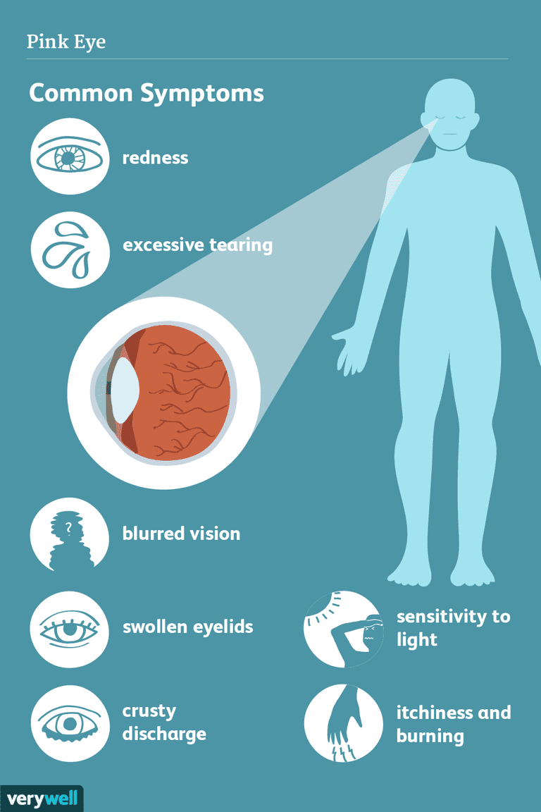 båda ögonen, allergisk konjunktivit, bakteriell konjunktivit, från ögat, inre ögonlocket