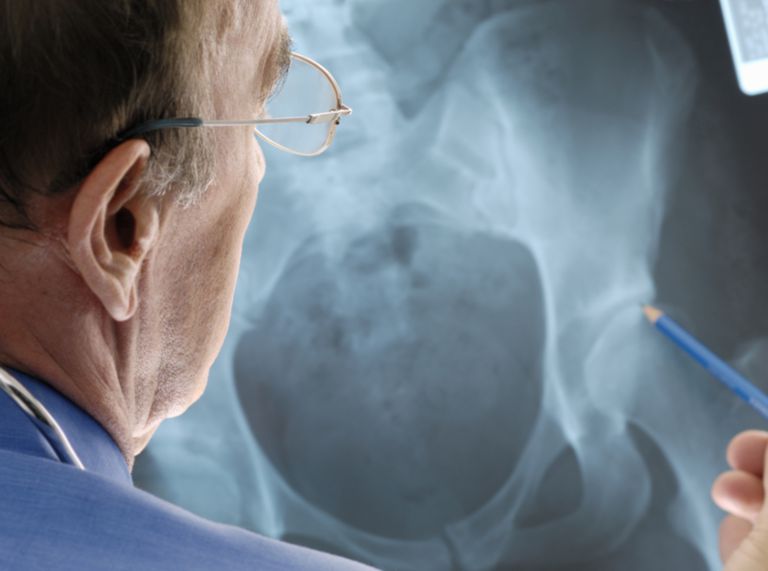 osteoporos höften, övergående osteoporos, Åldersrelaterad osteoporos, detta tillstånd