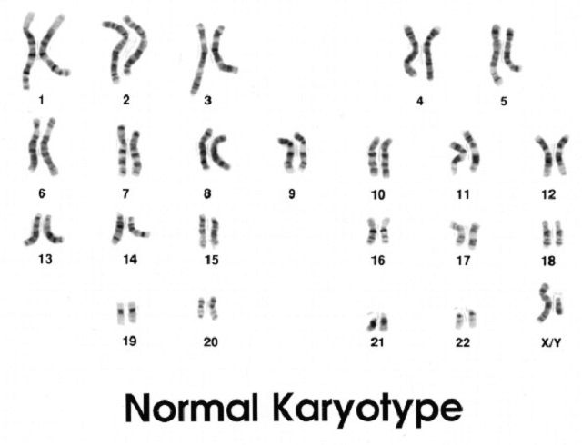 Downs syndrom, Enligt National, genetiskt problem, karyotyp avslöjar, syndrom kromosom, syndrom trisomi