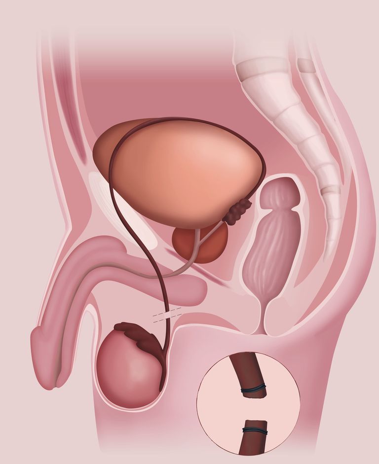 efter vasektomi, efter operationen, förhindra graviditet, efter proceduren, finns någon, från spermier