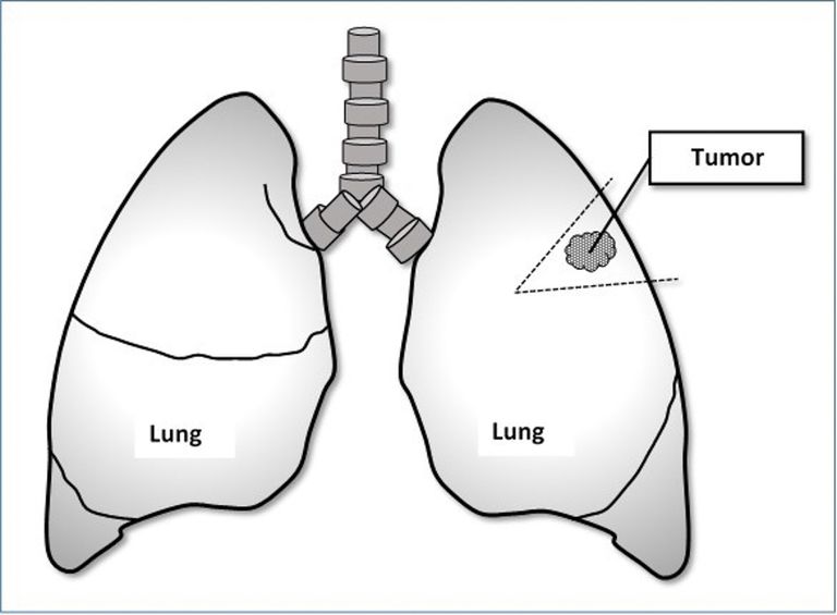 äldre lungcancer, tolerera proceduren, andra cancerformer, Denna procedur, hade kilresektion