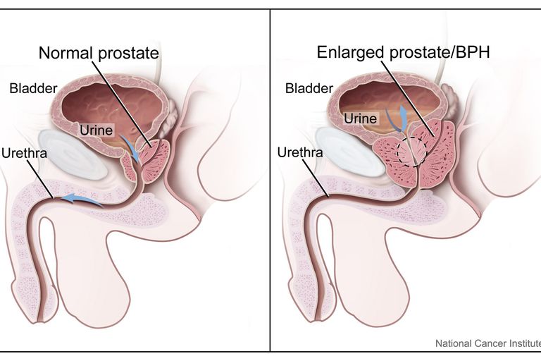 andra prostata, dess behandling, kronisk prostatit, många samma, ökar ålder, orsaka många