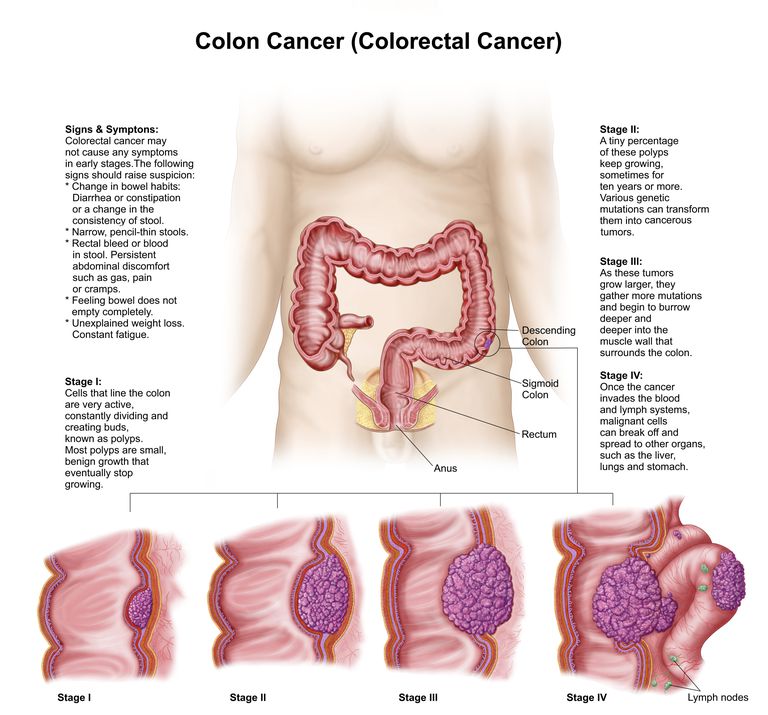 lymfkörtlar eller, kolorektal cancer, påverkar mellan, Cancer genom, alla lager