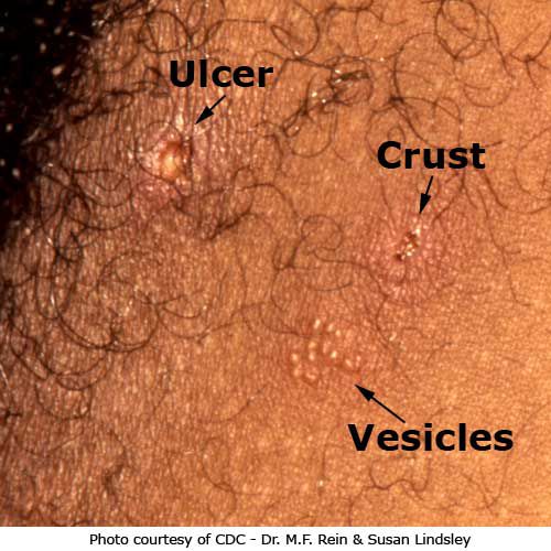 bild visar, Denna bild visar, Denna bild, genital herpes, herpes lesioner