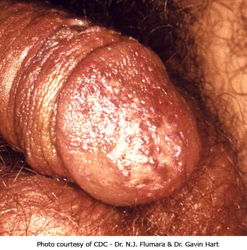 bild visar, Denna bild visar, Denna bild, genital herpes, herpes lesioner