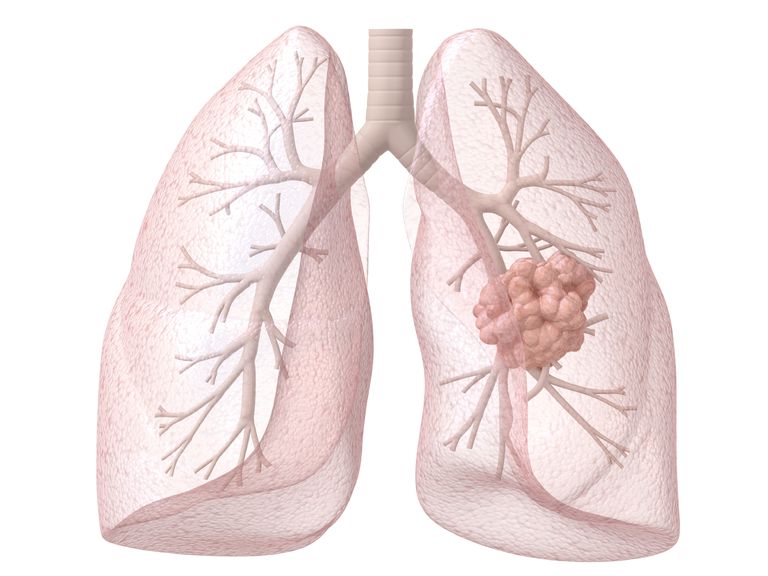 lungcancer tidigare, symptom lungcancer, aldrig rökare, behandling lungcancer, cirka procent, diagnostiserats lungcancer