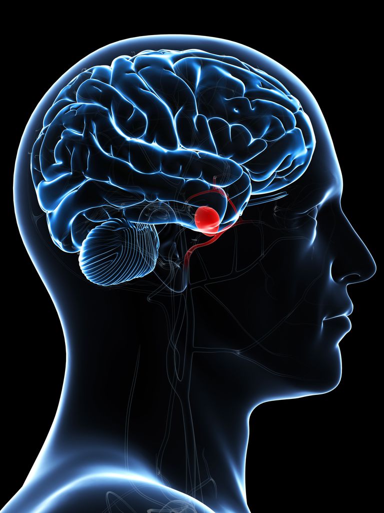 blodkärlets vägg, blödning hjärnaneurysm, Brain Brain, eller brista, finns några