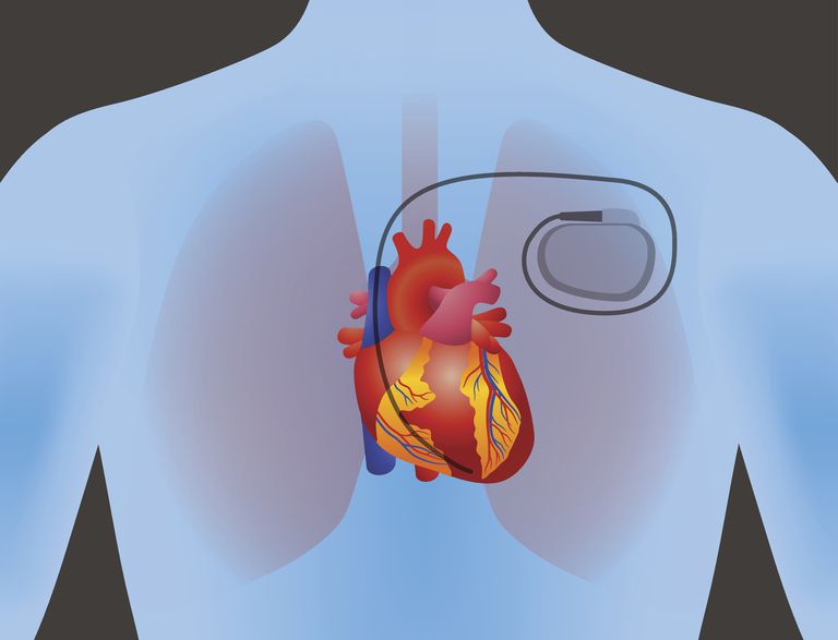 elektriska impulser, hjärtans elektriska, behöver pacemaker, ditt hjärtblock