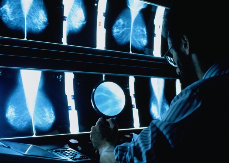 årligt mammogram, hade cancer, bara några, bröstet hade