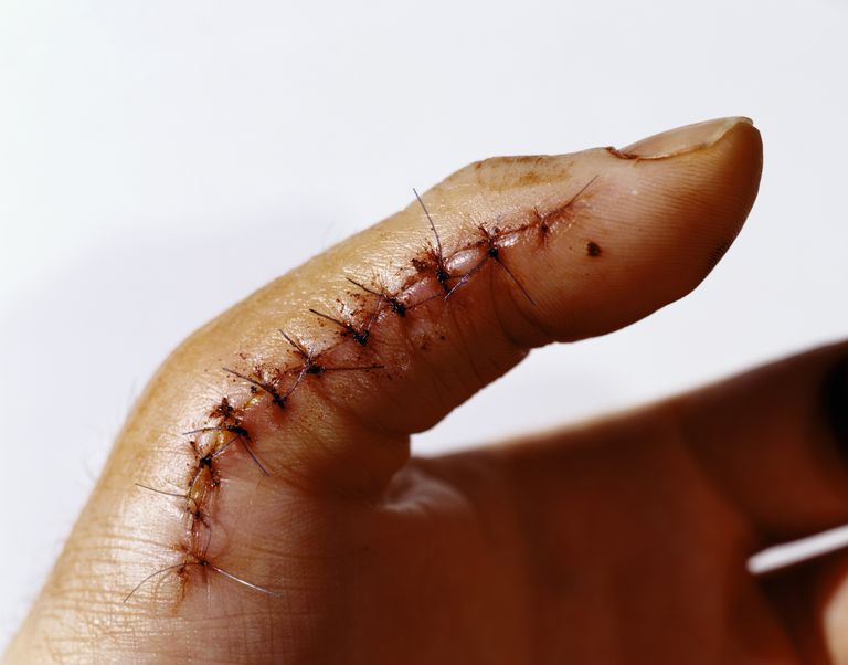 suturer används, Dessa suturer, dina suturer, inte bort